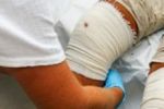 Máte lupénku? Poradíme s léčením ran Máte lupénku? Poradíme s léčením ran
